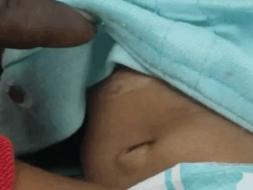 गर्म सरिये से एक साल की मासूम के लगाया डाम, सांप के फूंकार मारने पर करवाया था झाड़-फूंक